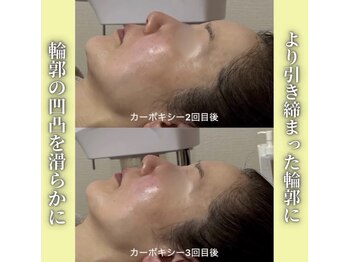 ハニエル(Haniel)/カーボキシー症例