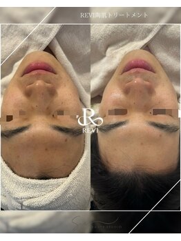 スア ビューティースタジオ(Sua BEAUTYSTUDIO)/繰り返すニキビ・肌荒れにstop