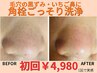 人気No2［毛穴黒ずみ・いちご鼻］角栓ごっそり毛穴洗浄 ¥4,980(通常6,000)