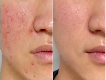 ビジュー(Bijou)の写真/繰り返す男のニキビ・肌荒れに！最強マシン【プラズマニア】１台７役の圧倒的アプローチで清潔肌にへ