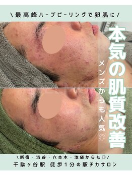 グリーンピール エルモナ(GREENPEEL ELMONA)の写真/「他のハーブピーリングでは満足できなかった」「ニキビ・毛穴・赤みが改善しない」そんなお悩みに。