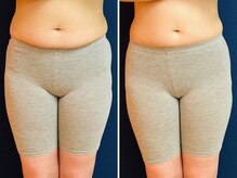 久留米スポーツ整骨院 整体院/エステ◆痩身インディバエステ