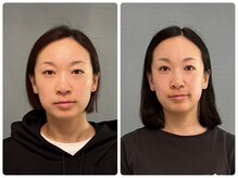 カナエルサロン 旭川(KANAERU SALON)/【小顔ケア】症例☆