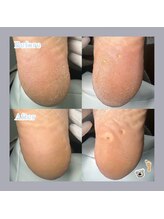 巻き爪補正店 天王寺店/踵にできた魚の目もスッキリ☆