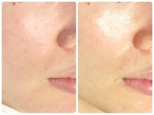 ラウン 京都(ROUN')/3回の施術ビフォーアフター