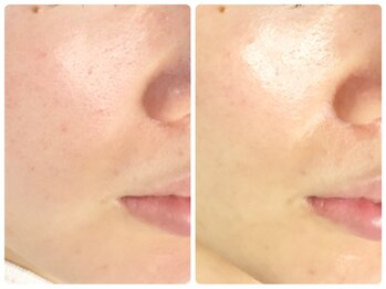 ラウン 京都(ROUN')/3回の施術ビフォーアフター