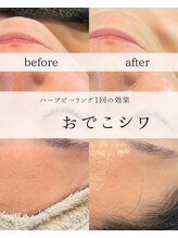 ワイシーハッチ(yc.hacci)/ハーブピーリング