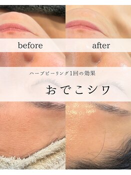 ワイシーハッチ(yc.hacci)/ハーブピーリング