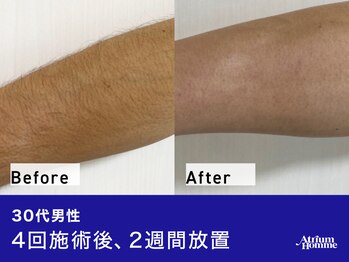 アトリウム オム 恵比寿店(ATRIUM HOMME)/腕脱毛ビフォーアフター