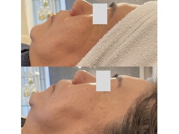 サロン ウェル(SALON WELL)/【ハーブピーリング B→A】