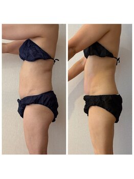 アイリーボーテ 東大阪(アイリーBEAUTE)/お腹引き締め