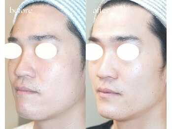 岩川治療院/ニキビ肌が改善へ