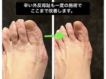 親指の変形や扁平足の施術はお任せください！