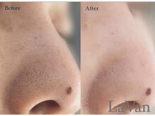 ラヴァン(LaVan)/毛穴ケア（１回）