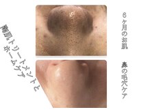 サロンデュ ひゃーく(Salon du ひゃーく)/鼻の毛穴ハーブピーリング改善