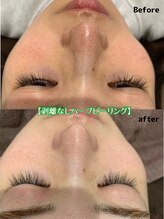 エリーザベル(Elisa Bell)/ハーブピーリング