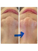 ブルームーン(Blue Moon)/毛穴洗浄　ビフォーアフター