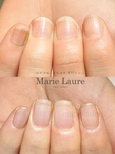 マリーロール 淀屋橋本店(Marie Laure)/自爪育成/深爪矯正/ネイルケア