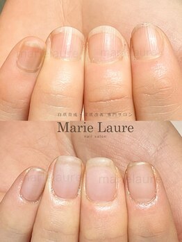 マリーロール 淀屋橋本店(Marie Laure)/自爪育成/深爪矯正/ネイルケア