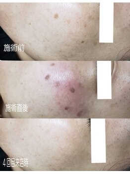 シェアキ(Chez Aki)/シミケアBefore/After