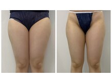 レミュ(Remu)/頑固な膝上もスッキリ