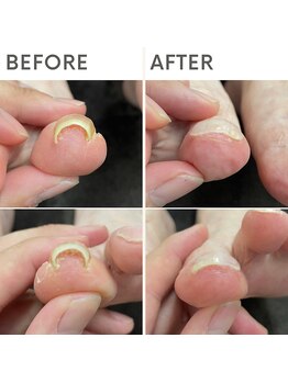 クオッカ(Quokka)/巻き爪ケア