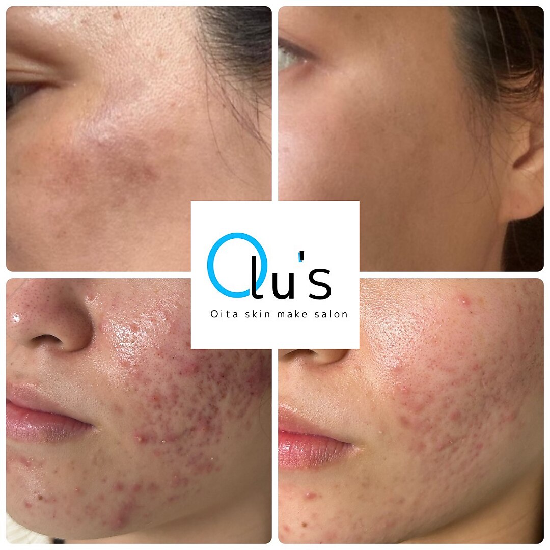大分駅で毛穴洗浄・毛穴吸引が人気のエステサロン｜ホットペッパー