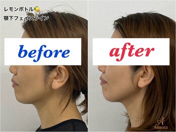 アモーラ(Amora)/レモンボトル顎下