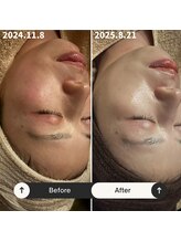 リマイン(Re mine)/トラブル肌も改善