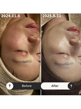 リマイン(Re mine)/トラブル肌も改善