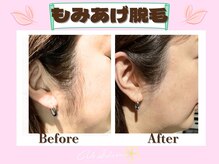 ヴィ シェーン(Vi Schoen)/もみあげ/お顔脱毛Before／After