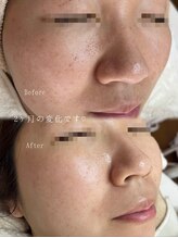 アトリーチェ ベレッツァ(ATTRICE Bellezza)/水素毛穴洗浄×マーメイド