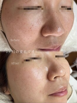 アトリーチェ ベレッツァ(ATTRICE Bellezza)/水素毛穴洗浄×マーメイド