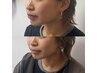 【2週間以内】メンテナンス小顔矯正