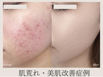 リトルーム(Litroom: from Seoul)の写真/敏感で弱ったお肌が改善!!韓国最先端技術で乾燥やかゆみや赤みも解消◎肌荒れケアして素肌自慢のお肌へ