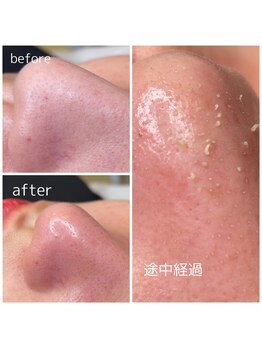 レイ(Rei)/毛穴エクストラクション