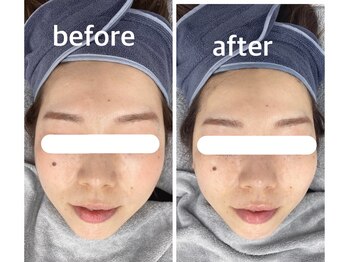 ハロ 南青山(HALO)/小顔フェイシャル三層打ち1回目