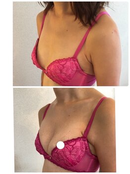 美人バスト 札幌店/バストアップ×育乳◇症例◇
