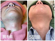 フォルトゥーナ ビューティー(Fortuna Beauty)の雰囲気（髭脱毛は2週間に1度施術可。髭剃りも快適に肌もキレイに／横浜店）