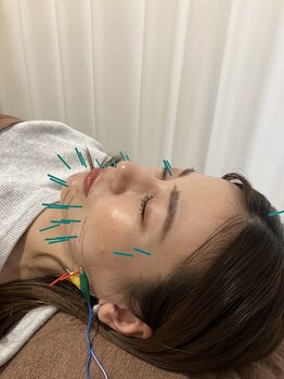 しみず鍼灸接骨院の写真/院長のイチ押しメニュー【期間限定★電気を流す美容鍼】7000円→4000円!!自信があるからこそこの価格♪