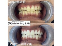 ホワイトニングバー アティ郡山店/12回コース終了ビフォーアフター