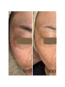 アンドエルビオ(&Elbio)/リゼネレート＋Wピーリング