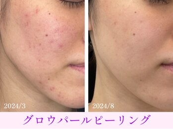 オーシャンブルー 大分店(OCEAN BLUE)/グロウパールピーリング