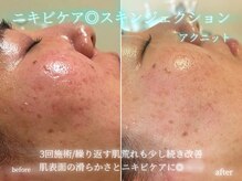 ラ ドゥーサ(La Dusa)/ニキビケア韓国最先端アクニット