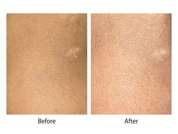 オーシャンブルー 大分店(OCEAN BLUE)/最新黒ずみケア《ローマピンク》