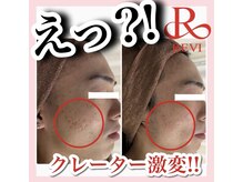 ホワイトアクア 天王寺本店(WHITE AQUA)/ハーブピーリング/大阪/天王寺