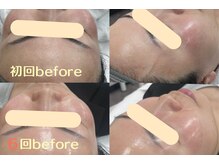 エスポワール(espoir)/初回before・６回目before