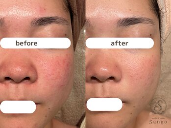 サンゴ(Sango)/ニキビ/毛穴/赤み改善