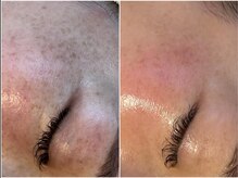 ダウンタイム無し！でも深部からお肌を育てるメニューを取り揃え