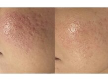 ブブオム 恵比寿本店(BUB OMME)/サーマトリックス